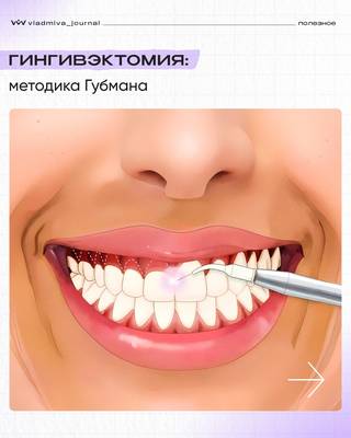 Гингивэктомия: пошаговая техника коррекции десневой улыбки.